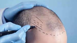 what is causing deaths post hair transplant