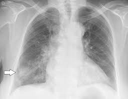 Abnormal chest x-ray: what does it mean? | Top Doctors