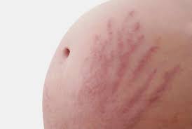The difference between red and white stretch marks - Times of India