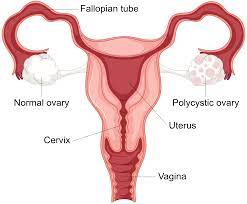 Polycystic ovarian syndrome (PCOS) | healthdirect